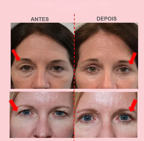 Levanta Pálpebras Caídas - Palp Lifting | Você mais bela o dia todo